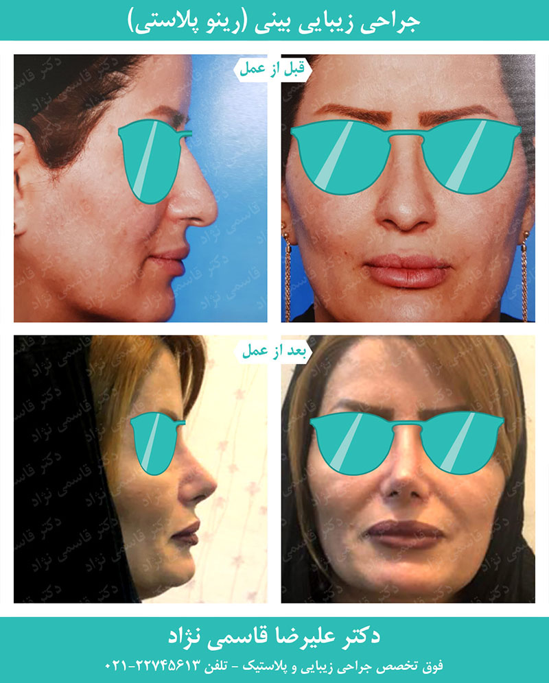 جراحی زیبایی بینی - رینوپلاستی